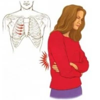 Лечение и симптомы межреберной невралгии