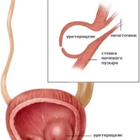 Лікування уретероцеле