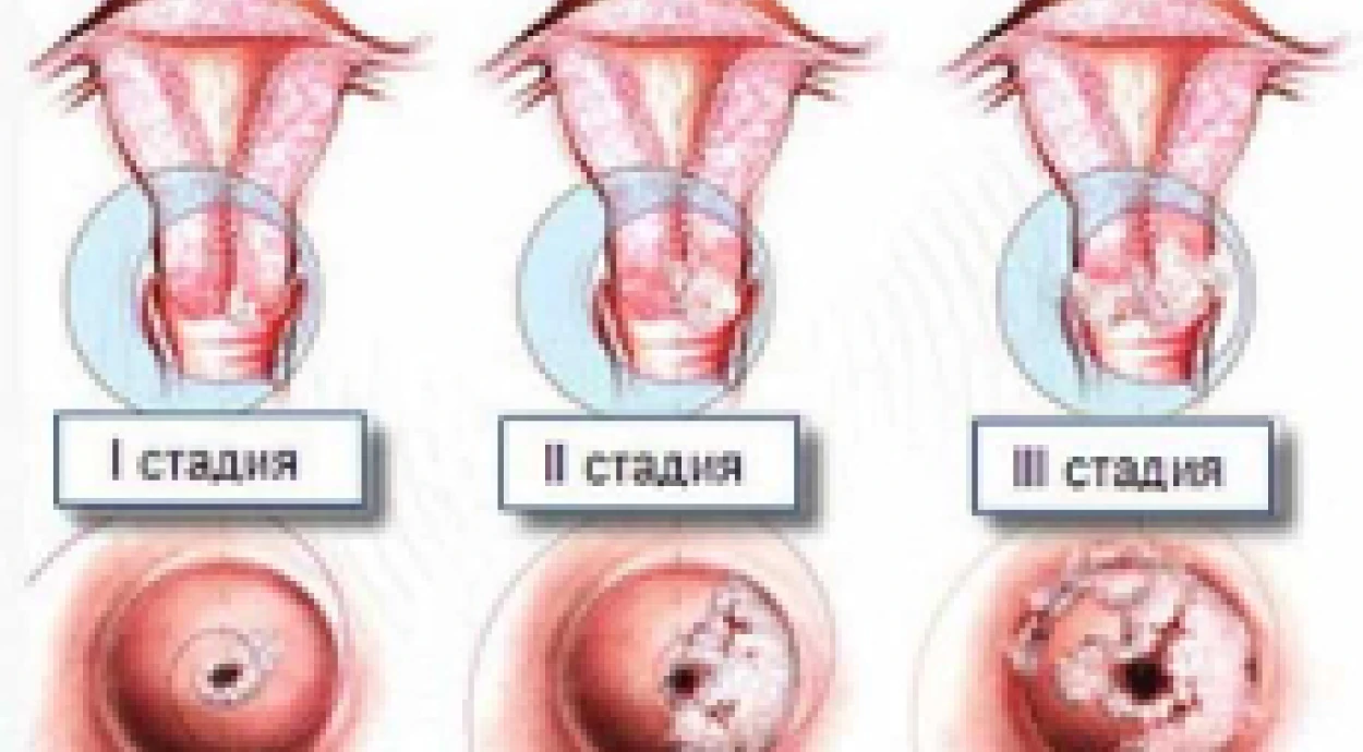 Лейкоплакия шейки матки: причины заболевания, его симптомы и методы лечения