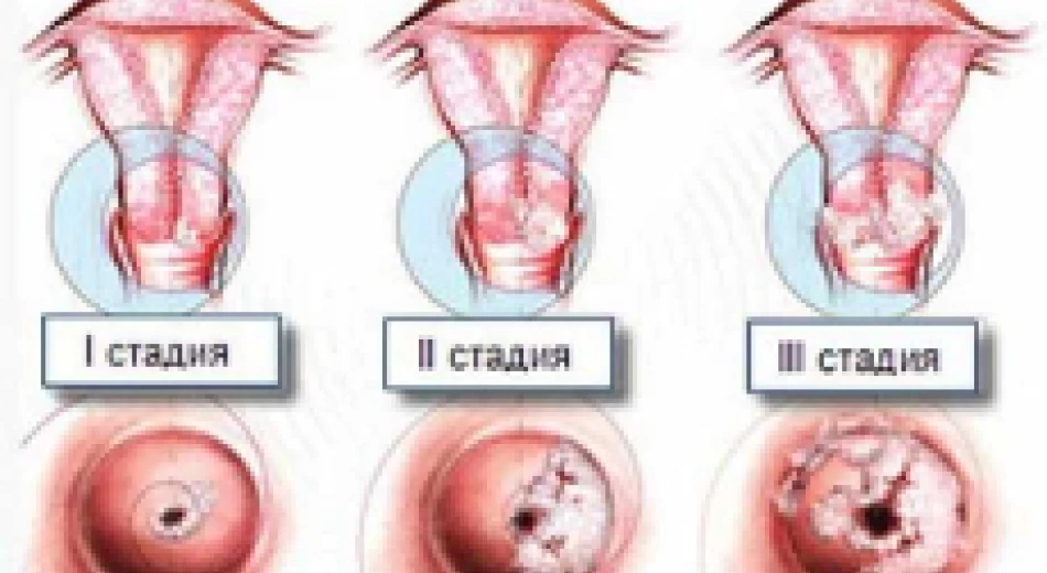 Лейкоплакия шейки матки: причины заболевания, его симптомы и методы лечения