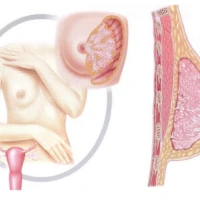 Мастопатия и беременность