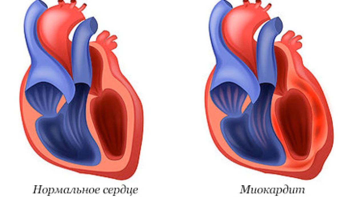 Миокардит: симптомы и методы лечения