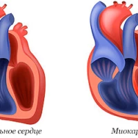 Миокардит: симптомы и методы лечения