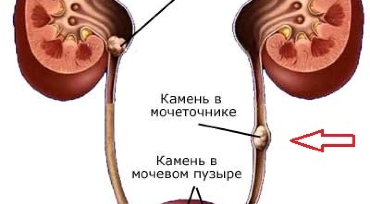 Мочекаменная болезнь
