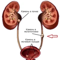 Мочекаменная болезнь