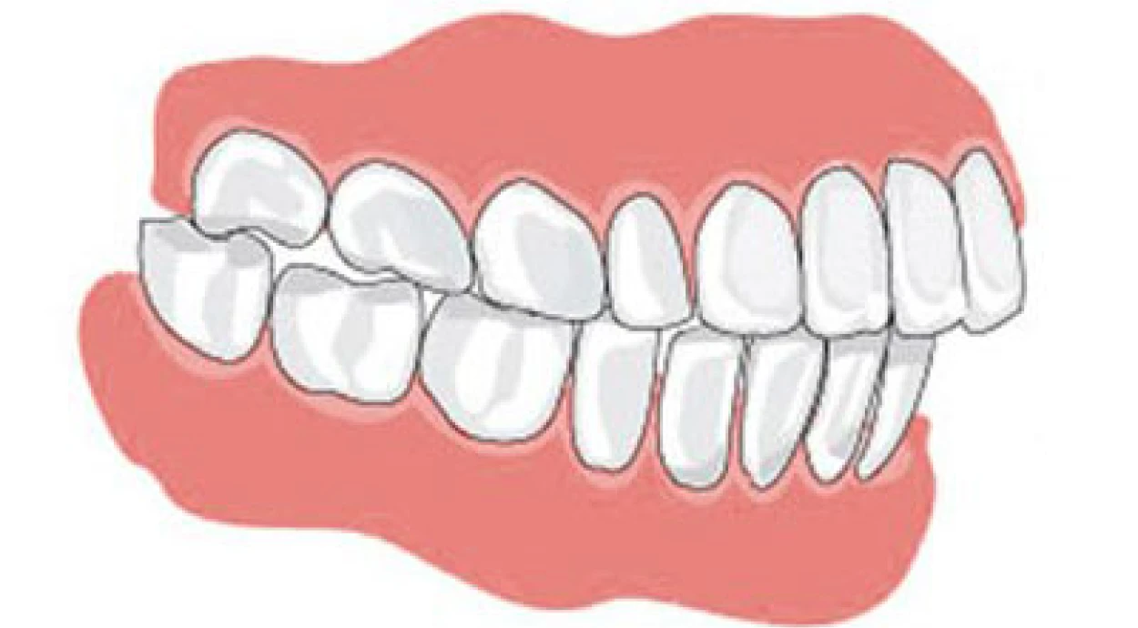 Нарушение прикуса ведет к серьезным последствиям!