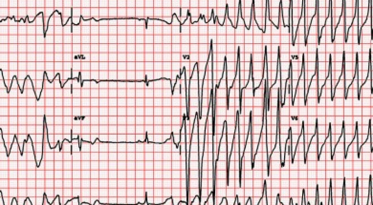 Нарушения сердечного ритма у детей