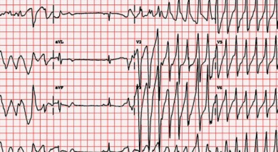 Нарушения сердечного ритма у детей