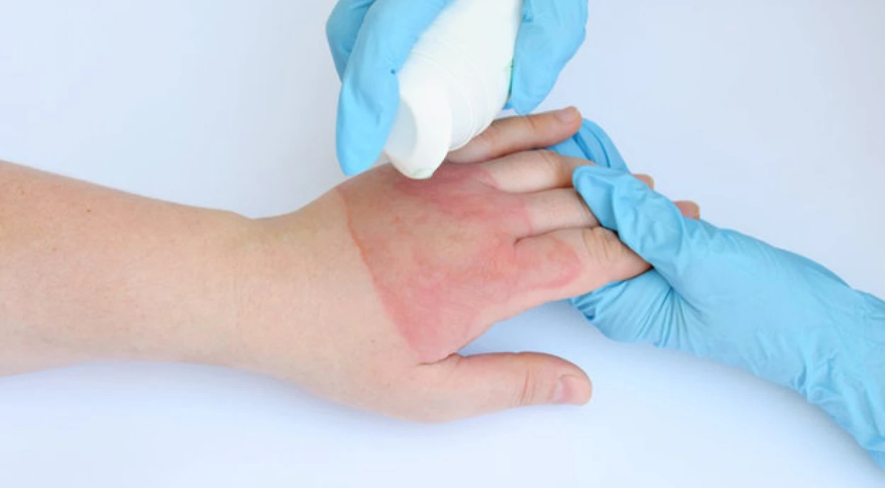 Опіки шкіри: правила першої допомоги та лікування