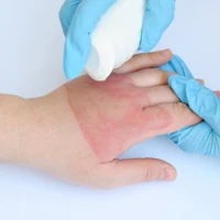 Опіки шкіри: правила першої допомоги та лікування