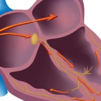 Особенности мерцательной аритмии