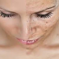 Пигментация кожи — причины, виды, лечение