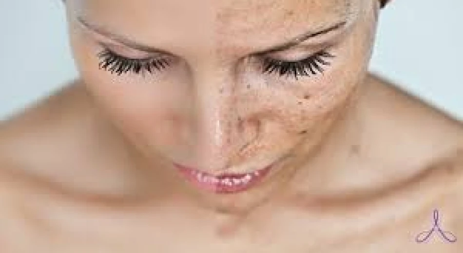 Пігментація шкіри: причини, види, лікування