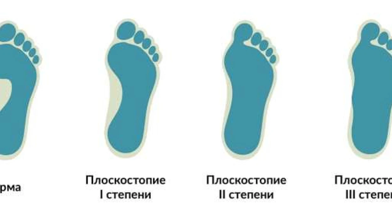 Плоскостопие у ребенка — что предпринять
