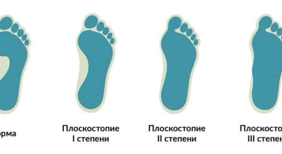 Дитяча плоскостопість – що робити