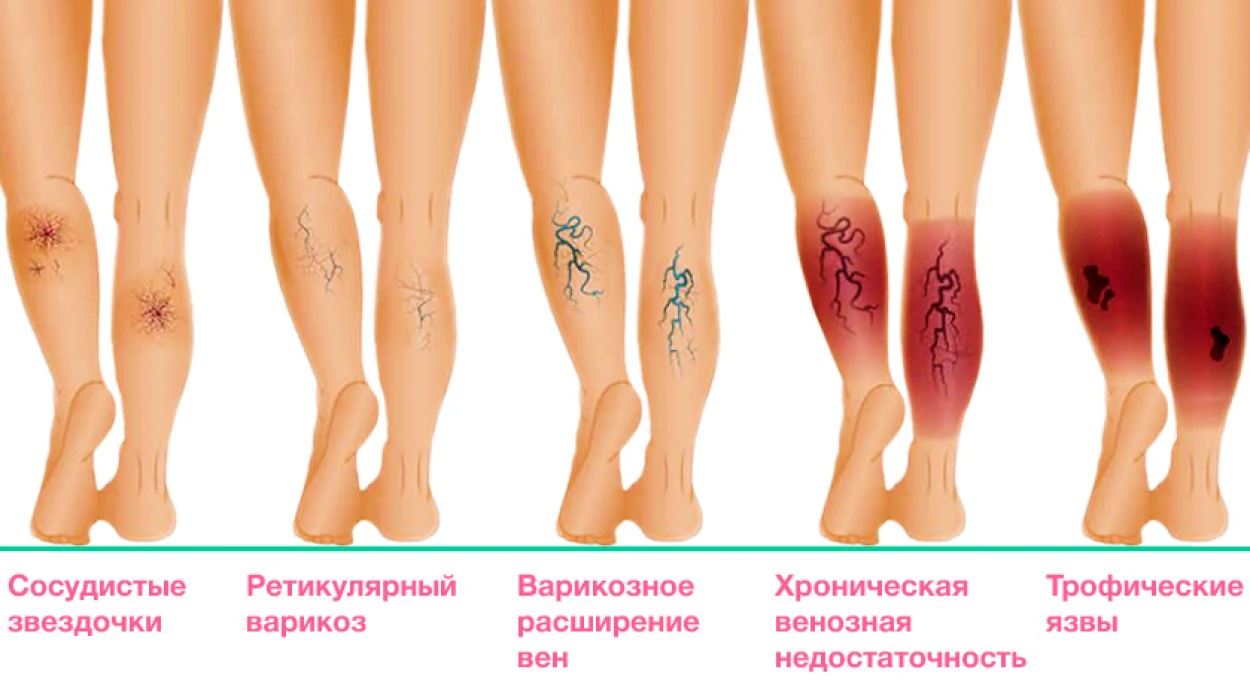 Почему развивается трофическая венозная язва на ноге и как ее лечить?