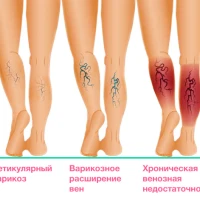 Почему развивается трофическая венозная язва на ноге и как ее лечить?