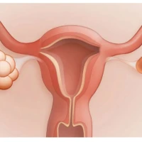 Поликистоз яичников