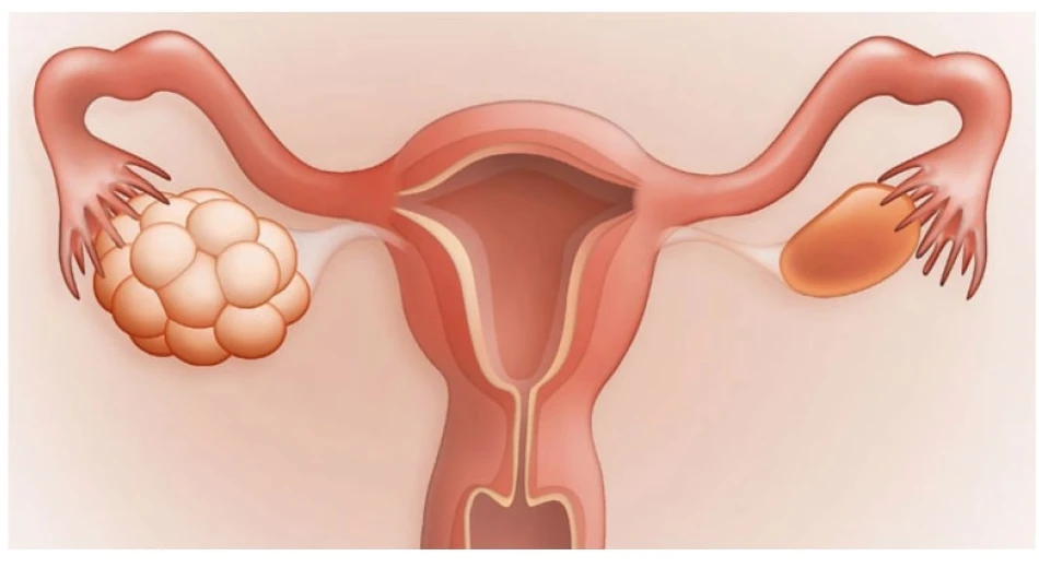 Поликистоз яичников