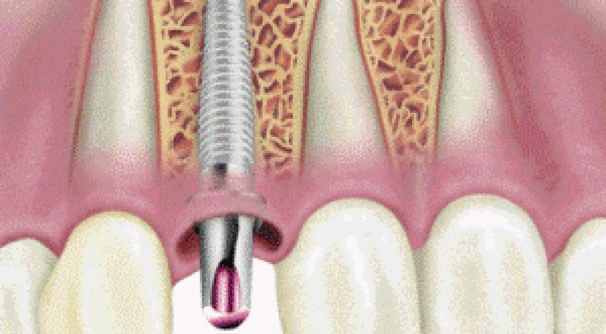 Правила поведения после имплантации зубов