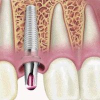 Правила поведения после имплантации зубов