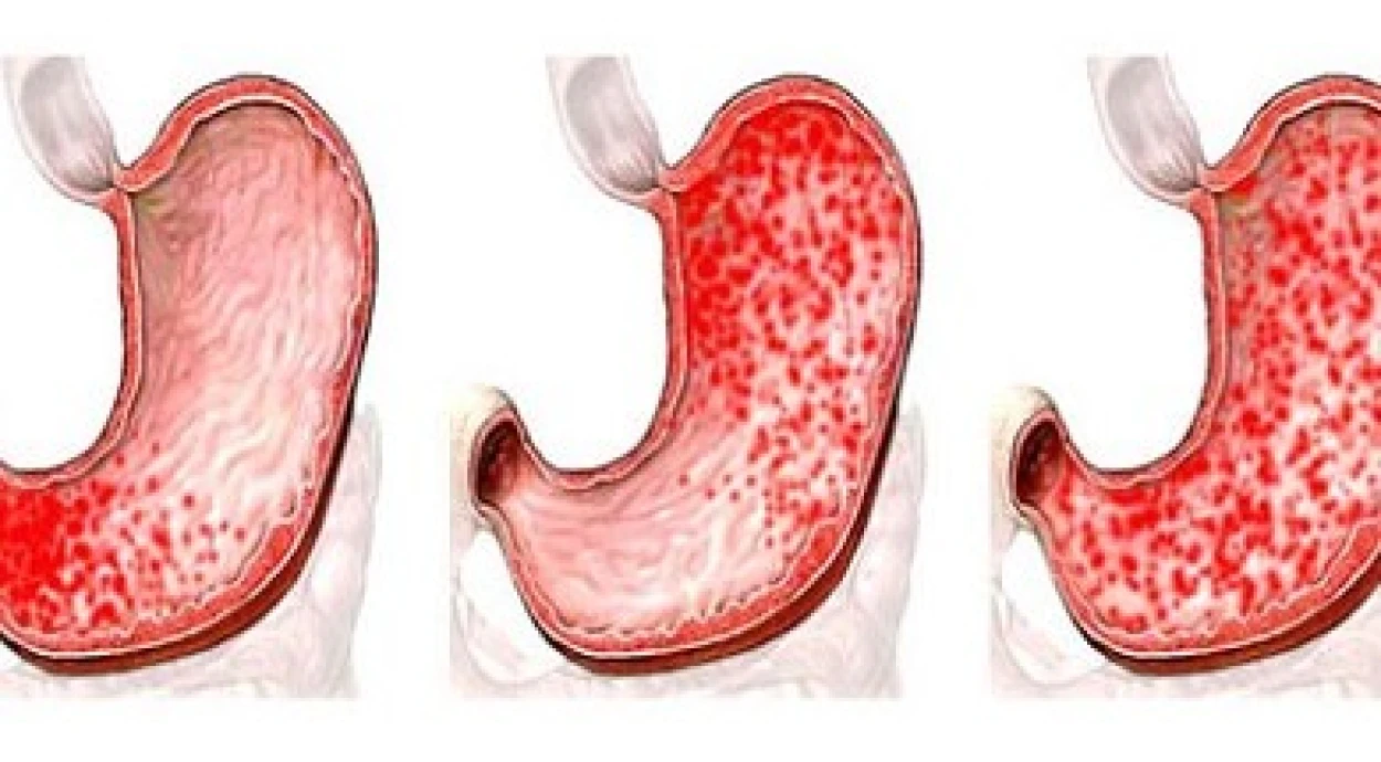 Причины возникновения и симптомы хронического гастрита