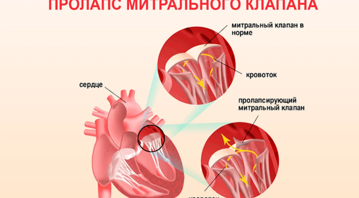 Пролапс митрального клапана: симптомы и методы лечения