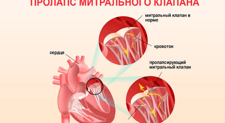 Пролапс митрального клапана: симптомы и методы лечения