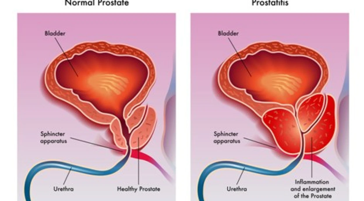 Простатит - угроза здоровью мужчин и женщин