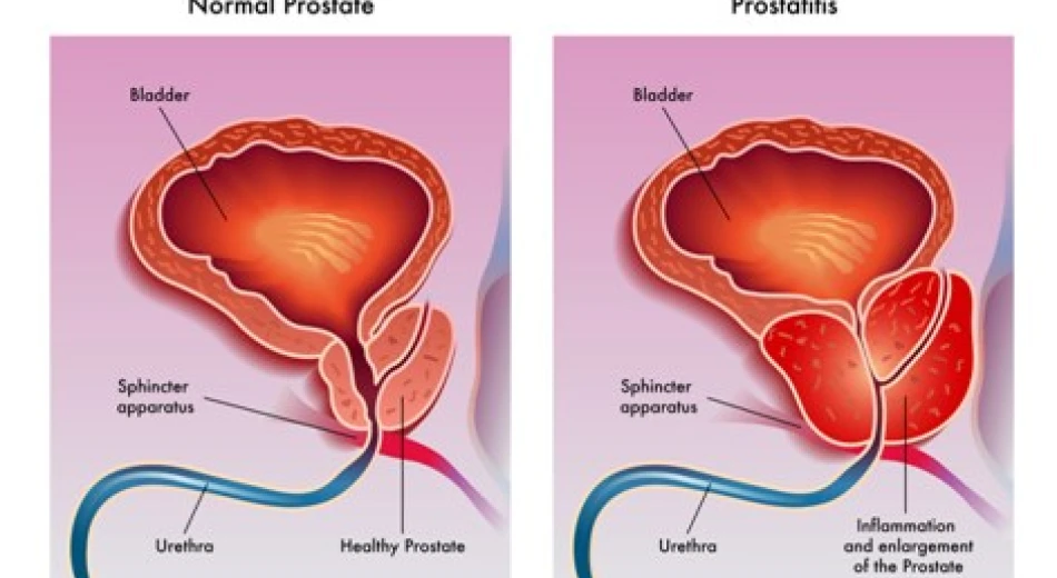 Простатит – загроза здоров'ю чоловіків та жінок