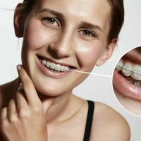 Прозрачные брекеты