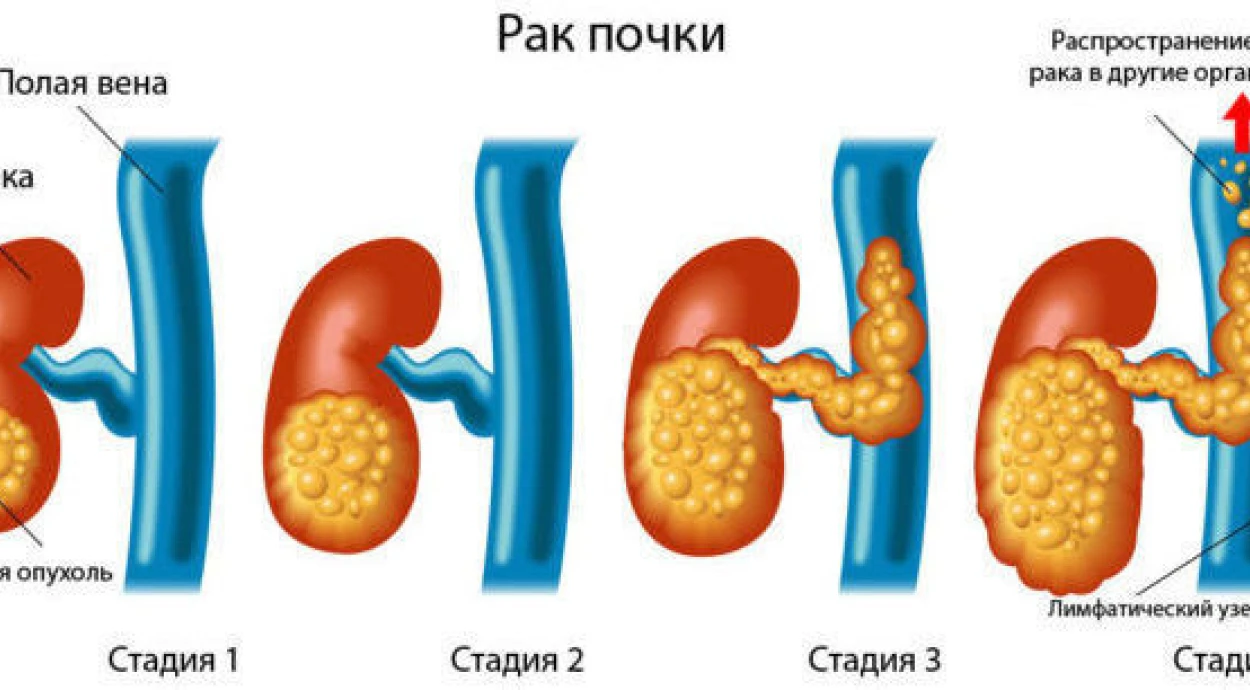 Рак почки: симптомы, диагностика и методы лечения