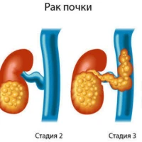 Рак почки: симптомы, диагностика и методы лечения
