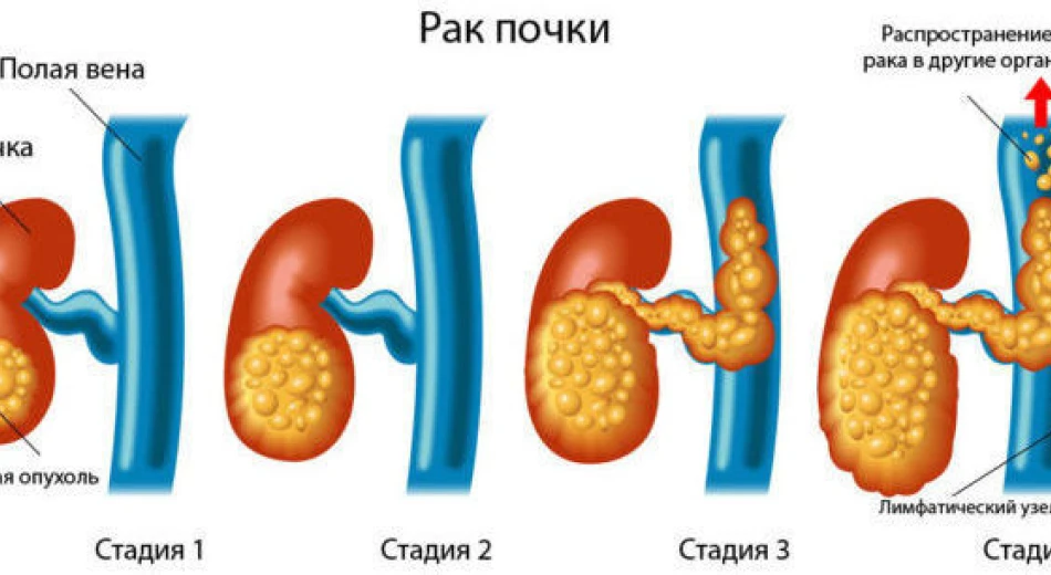 Рак почки: симптомы, диагностика и методы лечения