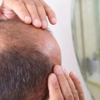 Раннее облысение — что делать? Признаки, причины, профилактика