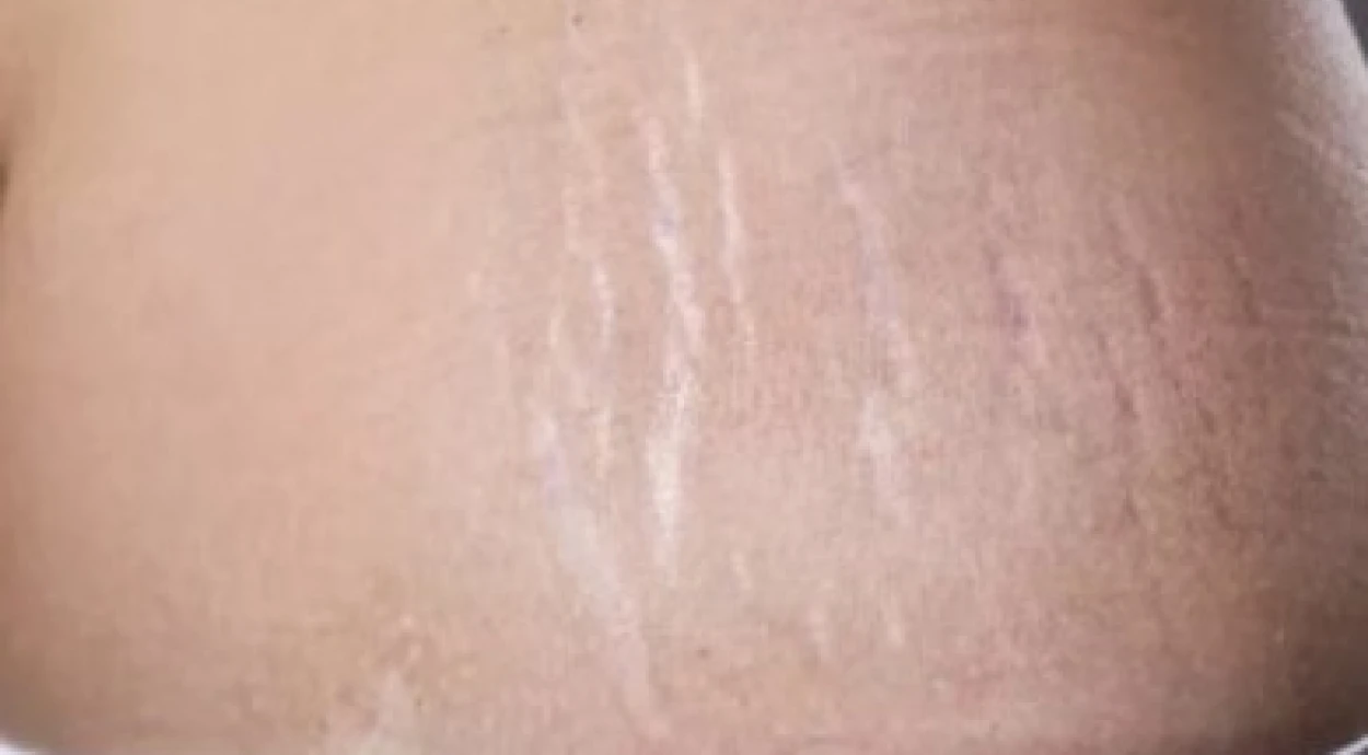 Розтяжки після пологів: вирок чи ні?