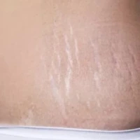 Растяжки после родов: приговор или нет