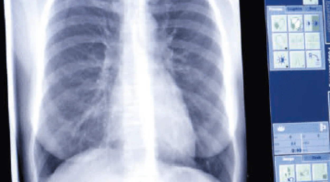 Рентген грудного відділу хребта