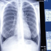 Рентген грудного отдела позвоночника