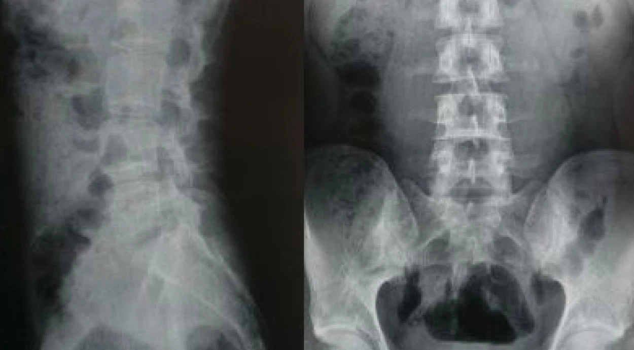 Рентген попереково-крижового відділу хребта