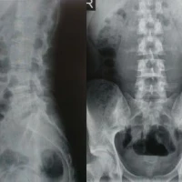 Рентген пояснично-крестцового отдела позвоночника