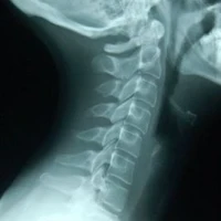 Рентген шейного отдела позвоночника