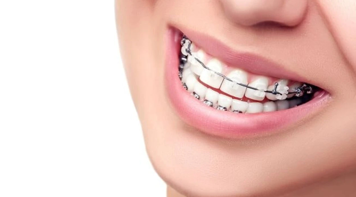 Что такое самолигирующие брекеты?