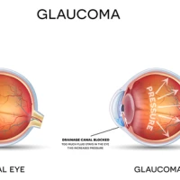 Симптомы, диагностика и методы лечения глаукомы