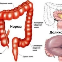 Симптомы долихосигмы и методы лечения