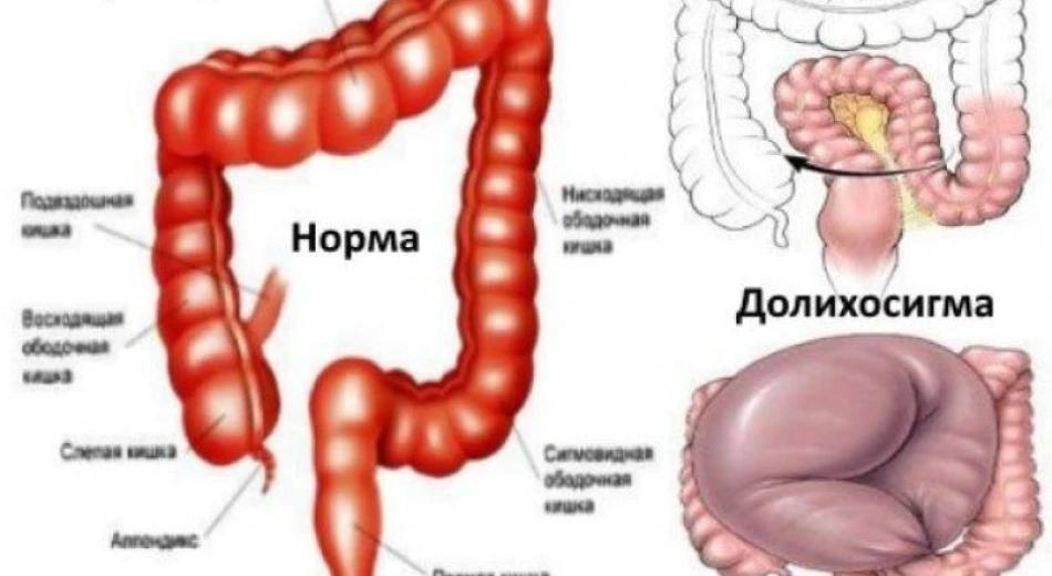 Симптомы долихосигмы и методы лечения