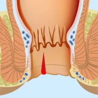 Симптомы и методы лечения хронической анальной трещины