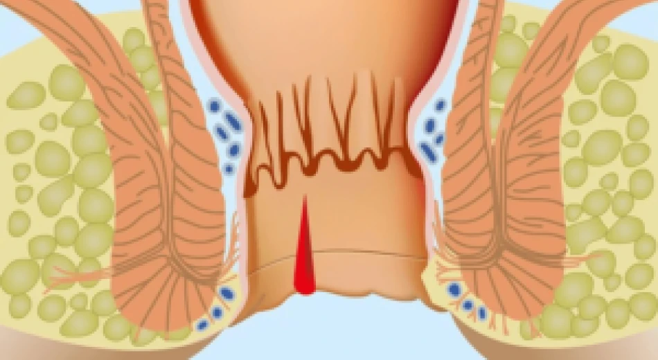 Симптоми та методи лікування хронічної анальної тріщини