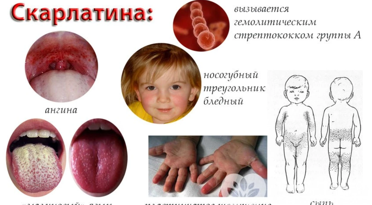 Scarlet fever: symptoms and treatment methods