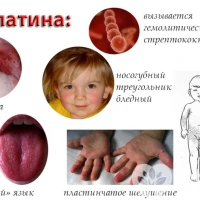 Скарлатина: симптомы и методы её лечения